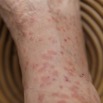 112 LOANGO Inyoungou Piqures Insectes sur le Pied de JLA 12E5K2IMG_79617wtmk.jpg