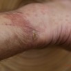 113 LOANGO Inyoungou Ampoule et Piqures Insectes sur le Pied de JLA 12E5K2IMG_79619wtmk.jpg